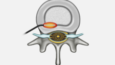 FLEXTRODE