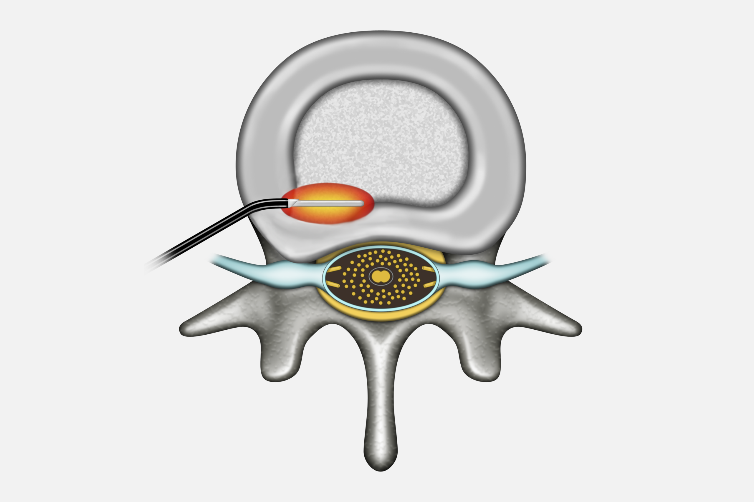 FLEXTRODE